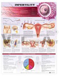 Infertility Anatomical Chart, 2nd Edition